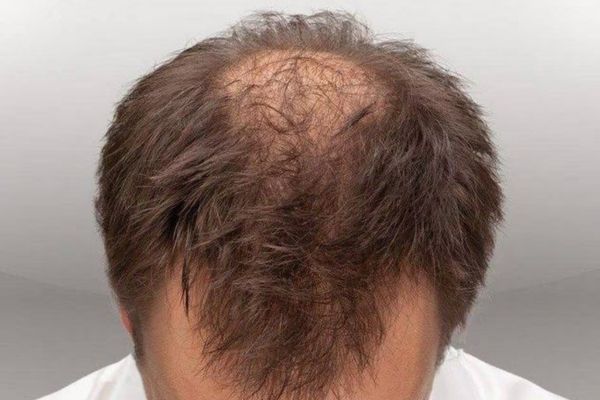 cheveux qui repoussent