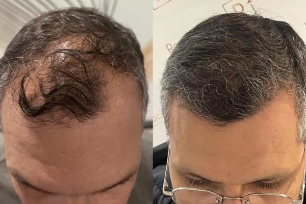 greffe cheveux france